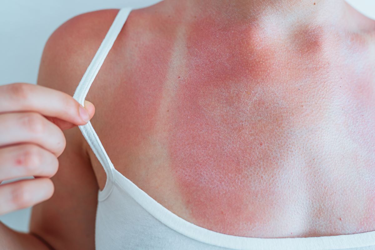 Sonnenbrand in Celle vermeiden, richtig behandeln und ernst 